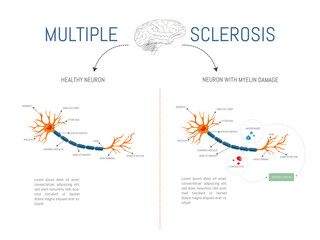 Infographic of a healthy neuron and one with damage from attack by myelin-destroying lymphocytes and macrophages in multiple sclerosis disease.