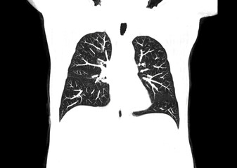 CT scan of Chest or lung  at radiology department in hospital. Covid-19 scan body xray test detection for covid virus epidemic spread concept