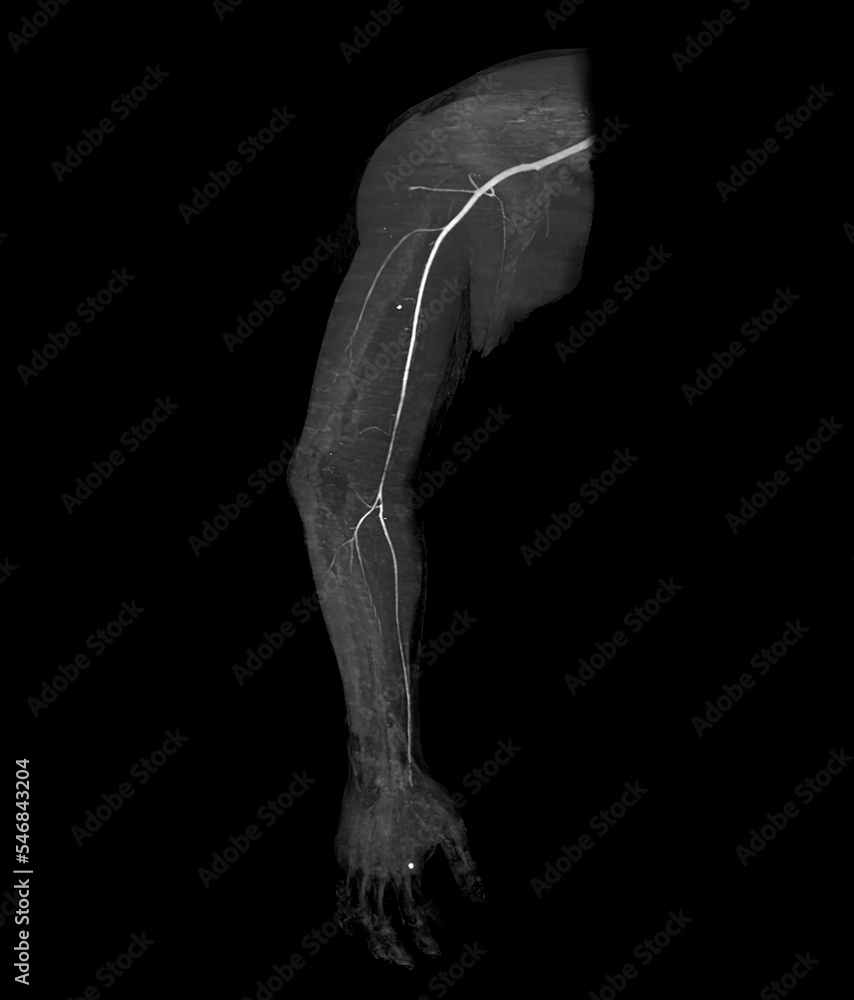 Poster cta brachial artery or ct scan of upper extremity 3d rendering image .