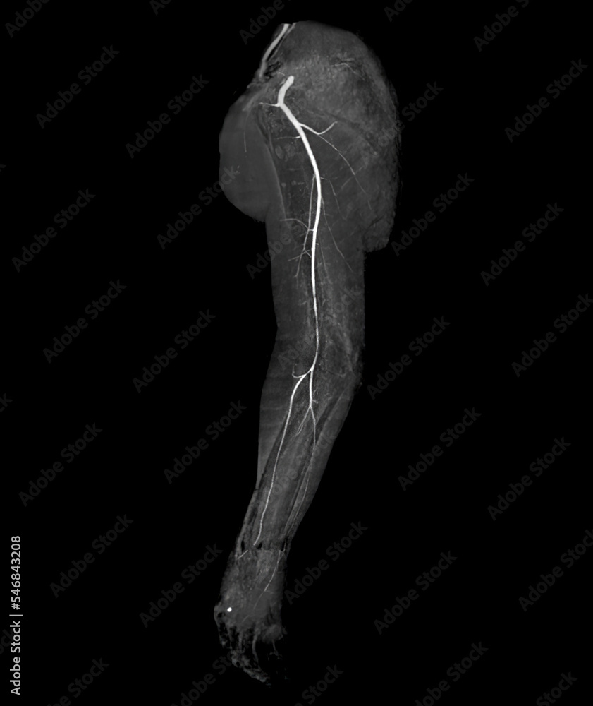 Poster cta brachial artery or ct scan of upper extremity 3d rendering image .