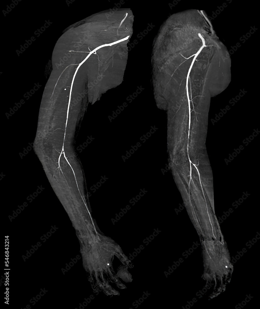 Poster cta brachial artery or ct scan of upper extremity 3d rendering image .