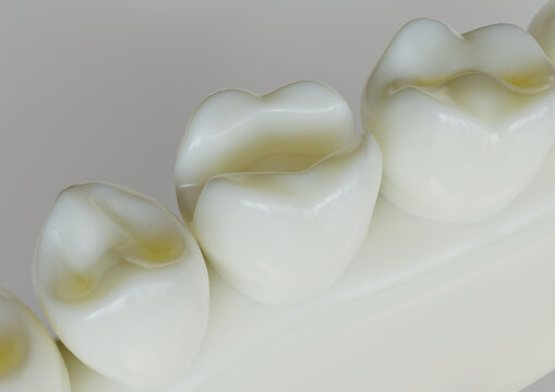 removed amalgam filling from a tooth- 3D Rendering