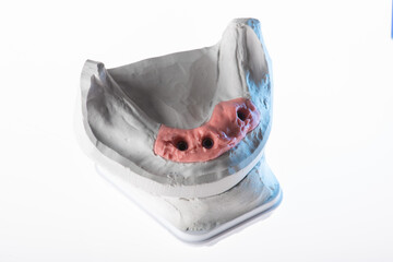Implantat Gipsmodell, auch Arbeitsmodell in der Zahnarztpraxis, freigestellt, Untergrund weiß.