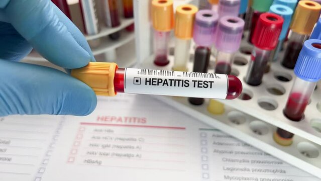 Doctor holding Blood sample tube for analysis of Hepatitis in the laboratory. Technician lab with Blood testing over requisition report for Hepatitis test