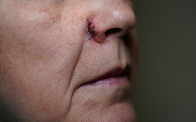 Fototapeta premium Woman with human papillomas operated on the nose, surgical stitches.