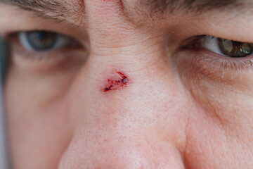 close-up. bloody abrasion on the bridge of the nose of a man after a blow. 