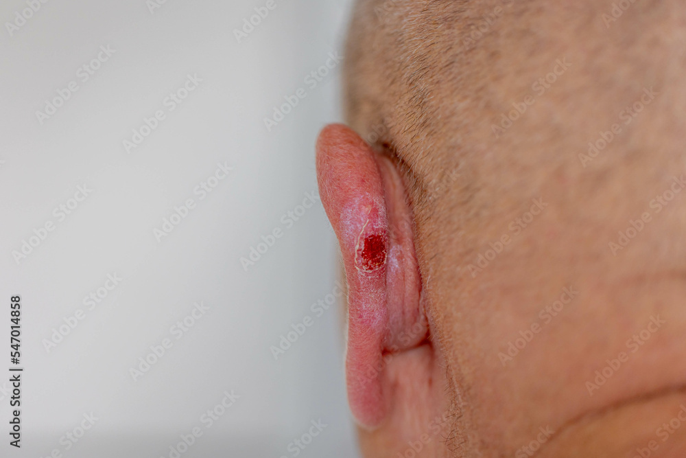 Wall mural healthcare and medical concept, selective focus of back side of a man with grey hair, the ear with l