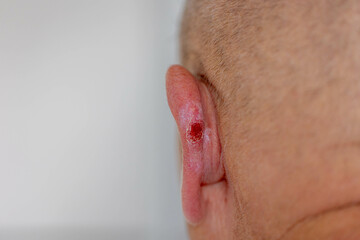 Healthcare and medical concept, Selective focus of back side of a man with grey hair, The ear with...