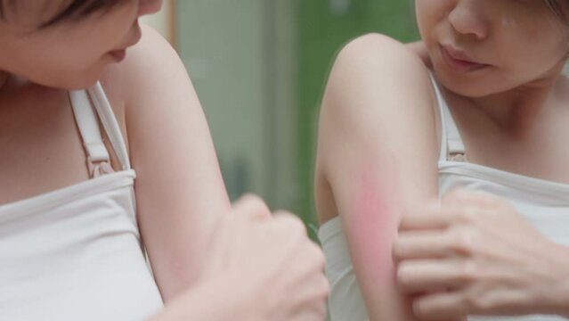 skin problem and beauty. Young woman scratch body has itchy skin from skin allergic, steroid allergy, sensitive skin, red from sunburn, chemical allergy, rash, insect bites, Seborrheic Dermatitis.