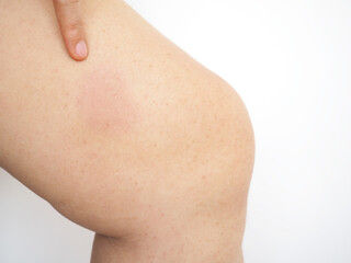 Young woman touching leg with bruises on white background. Closeup photo, blurred.