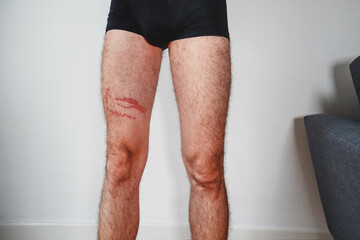 A jellyfish sting burn on a man's leg © Andrei Antipov