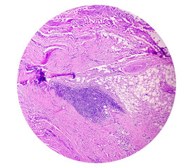 Microscopic examination of thyroglossal duct cyst. Persistent thyroglossal duct.