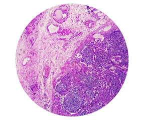 Microscopic view of Trichomonas vaginalis in pap smear with few acute inflammatory cells. Cytology...