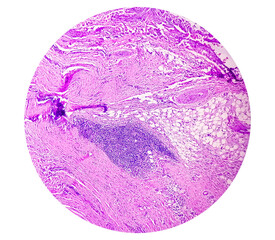 Microscopic examination of thyroglossal duct cyst. Persistent thyroglossal duct.