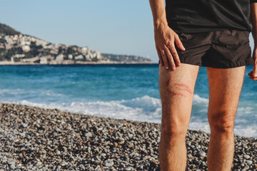A jellyfish sting burn on a man's leg, on the beach © Andrei Antipov