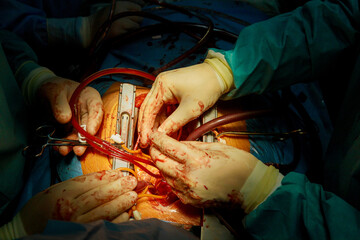 As result of malfunctioning the heart valve, patient undergoes open heart surgery, which involves a...