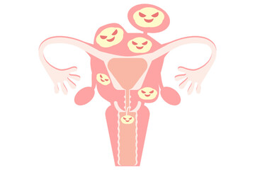 多発性子宮筋腫