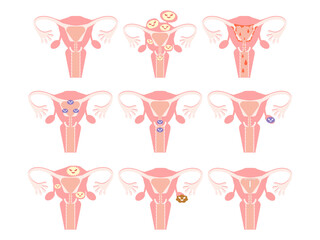 子宮　病気　状態セット