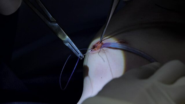 Surgeon sews wound on breast during plastic surgery. Close-up of a doctors hands sutures breast after breast augmentation surgery with neat stitches