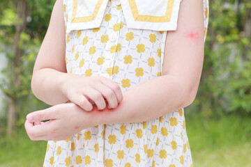 Little girl has skin rash allergy itching and scratching on her arm - obrazy, fototapety, plakaty