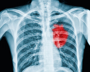 x-ray red heart of human Inflammation and signs of a red heart (heart disease)                                           