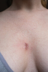Fototapeta premium A wound that heals and turns into a scar after removing a cyst on a woman's breast. A wound on chest. 
