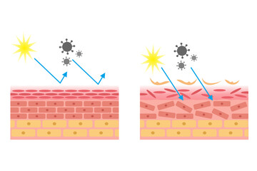 vector illustration of healthy and damaged skin anatomy comparison. epidermis and desmis of the skin. illustration for skin medical science and health.
