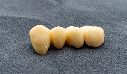 Provisional dental bridge isolated on grey background. Temporary resin teeth. Dental health and implant concept