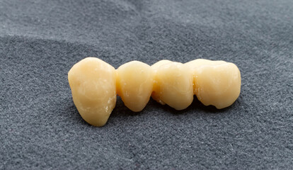 Provisional dental bridge isolated on grey background. Temporary resin teeth. Dental health and...