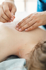 Obraz na płótnie Canvas Woman stabbed in the back with needle in bright acupuncture clinic