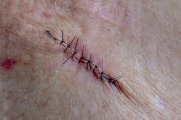 Healthcare and medical concept, Close up man chest with surgical wound suture after operation, Basal-cell carcinoma (BCC) also known as basal-cell cancer is the most common type of skin cancer.