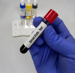 Blood sample for Serum Urate test. Uric acid.