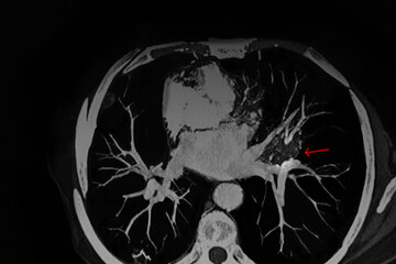CAT Scan image pulmonary angiography showing lung adenocarcinoma with red arrow. Medical themes