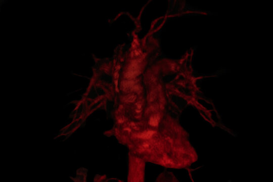 CAT Scan image pulmonary angiography showing lung adenocarcinoma. Medical themes