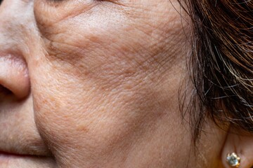 Wrinkles and loosening skin in the face of Chinese elder woman