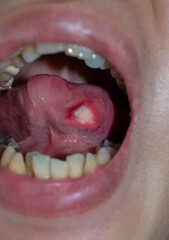 Obraz premium Ulcer at the tongue of Asian patient. Diagnosis may be aphthous ulcer, canker sore, stress ulcer or tongue cancer.