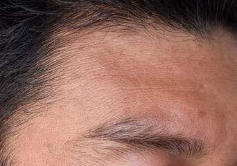 Obraz premium Skin creases or wrinkles at the forehead of Asian, Myanmar or Burmese man. Symptom of aging.