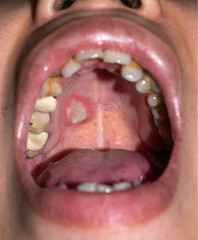 Aphthous ulcer or stress ulcer in mouth of Asian patient.