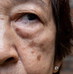 Small brown patches called age spots on face of Asian elder woman. They are also called liver...