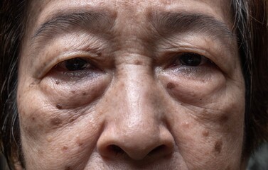 Small brown patches called age spots on face of Asian elder woman. They are also called liver...