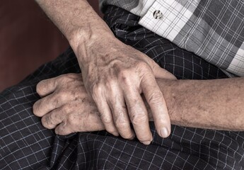 Age spots on hands of Asian man. They are brown, gray, or black spots and also called liver spots,...
