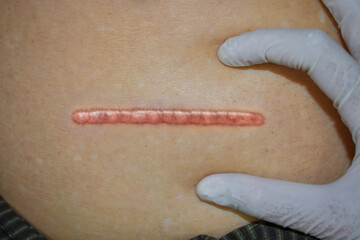 Neat, tidy and clean keloid scar. Straight surgical incision.