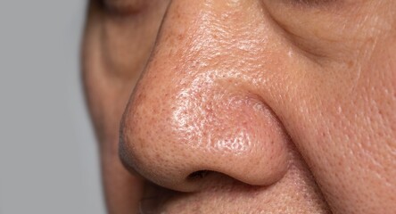 Widening pores in the nose of Asian man.