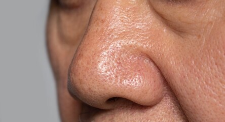 Widening pores in the nose of Asian man.