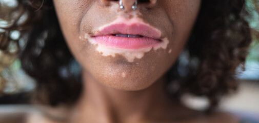 Close up of skin disorder of young african woman with Vitiligo.