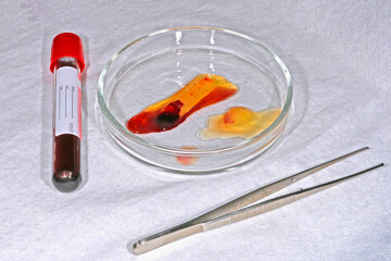 Clots of Platelets Reach Fibrin. PRF conglomerates after centrifugation in a medical petri dish