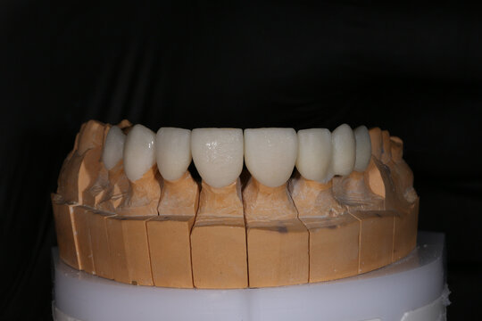 Ceramic crowns and veneers on a gypsum model. Zirconia crowns. Metal-free ceramics at the manufacturing stage. Close-up