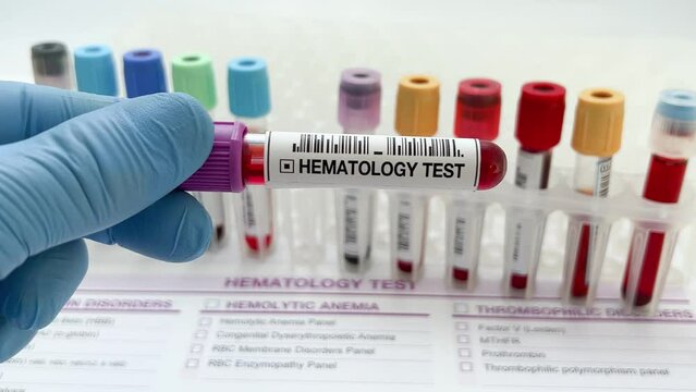 Doctor holding Blood sample tube for analysis in Hematology laboratory. Lab technician assistant or doctor holding a blood testing over requisition report for Hematology test
