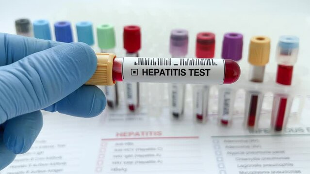 Doctor holding Blood sample tube for analysis of Hepatitis in the laboratory. Lab technician assistant or doctor holding Blood testing over requisition report for Hepatitis test