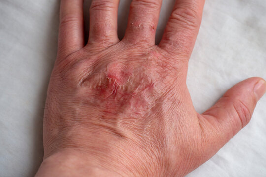Thermal burn of the skin of the hand. Healing wound close up.